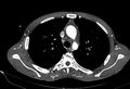 Coarctation of aorta with aortic valve stenosis (Radiopaedia 70463-80574 A 48).jpg