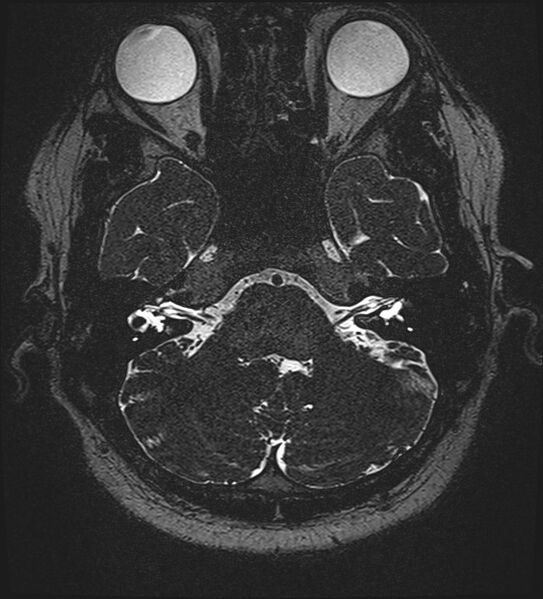 File:Cochlear incomplete partition type III associated with hypothalamic hamartoma (Radiopaedia 88756-105498 Axial T2 71).jpg