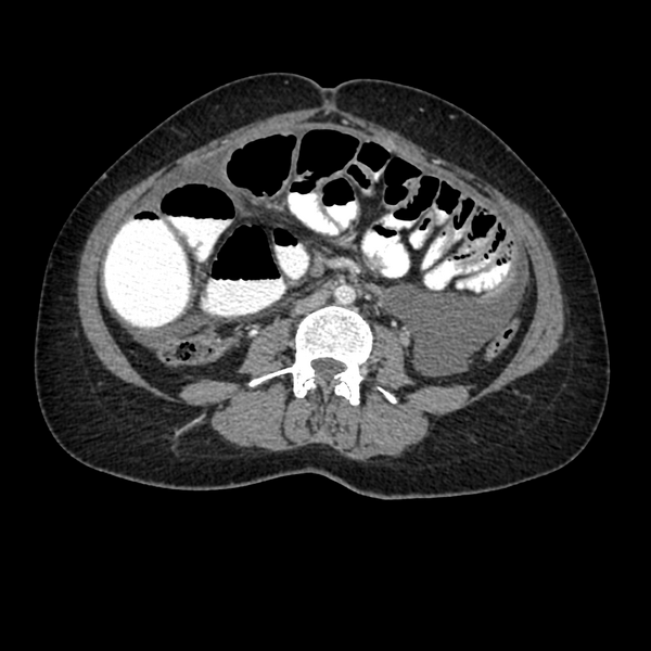 File:Cocoon abdomen with possible tubo-ovarian abscess (Radiopaedia 46235-50636 A 24).png