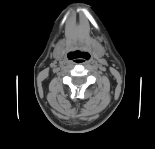 File:Colloid cyst of thyroid (Radiopaedia 22897-22923 Axial non-contrast 22).jpg