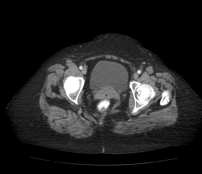 File:Colonic diverticulosis (Radiopaedia 22934-22957 A 70).jpg