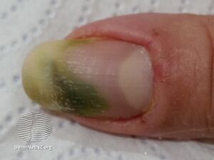 Green nail due to pseudomonas infection with paronychia (DermNet NZ green-nail).jpg