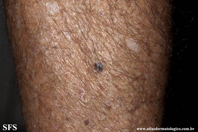 File:Melanoma (Dermatology Atlas 87).jpg