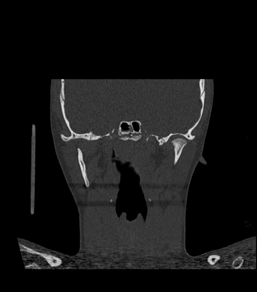 Nasoorbitoethmoid fracture (Radiopaedia 90044-107205 Coronal bone window 87).jpg