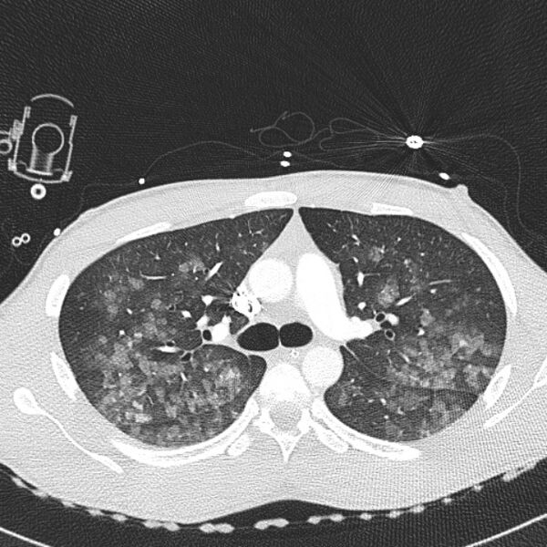 File:Near drowning (pulmonary edema) (Radiopaedia 24685-24958 lung window 11).jpg