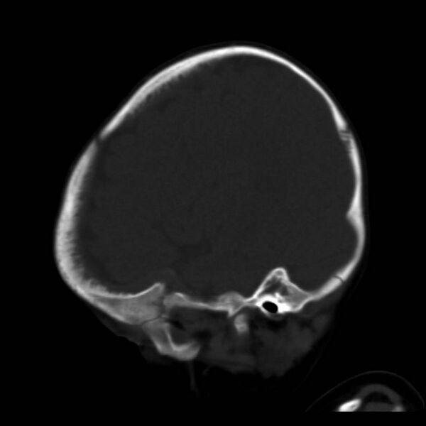 File:Neuroblastoma with skull metastases (Radiopaedia 30326-30958 Sagittal bone window 33).jpg