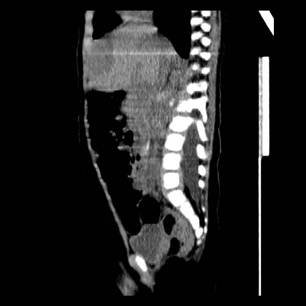 File:Neuroblastoma with skull metastases (Radiopaedia 30326-30960 B 20).jpg