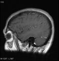 Neurosarcoidosis (Radiopaedia 10930-17204 Sagittal T1 C+ 15).jpg