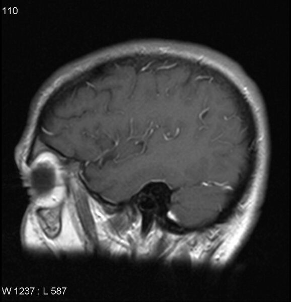 File:Neurosarcoidosis (Radiopaedia 10930-17204 Sagittal T1 C+ 15).jpg