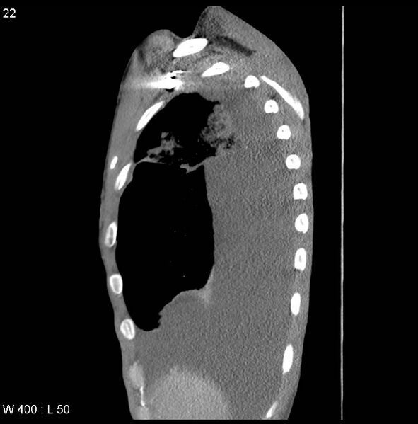 File:Non-Hodgkin lymphoma involving lung (Radiopaedia 29094-29470 D 13).jpg