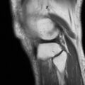 Non-displaced patella fracture (Radiopaedia 15932-15582 Sagittal T1 17).jpg