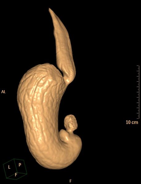 File:Normal CT virtual gastroscopy (Radiopaedia 29960-30501 3D VG 2).jpg