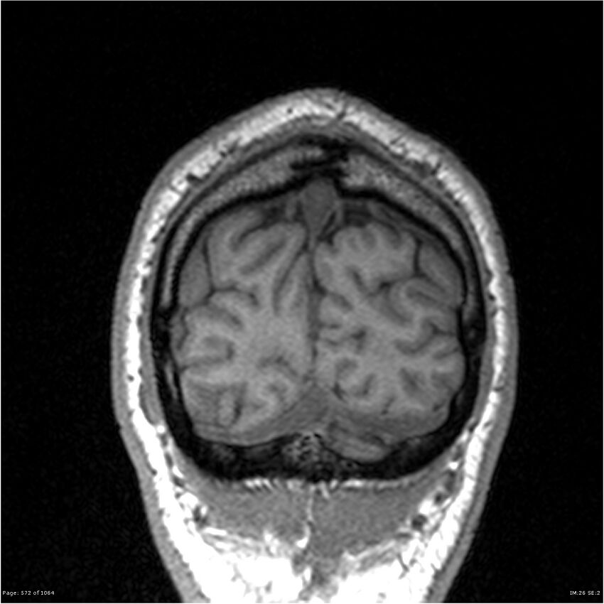 Normal brain MRI (non-focal epilepsy protocol) (Radiopaedia 38571-40700 Coronal T1 12).jpg