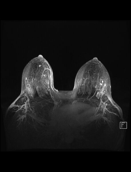 File:Normal breast MRI - dense breasts (Radiopaedia 80454-93850 Axial MIPS 3).jpg