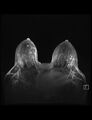 Normal breast MRI - dense breasts (Radiopaedia 80454-93850 Axial MIPS 3).jpg