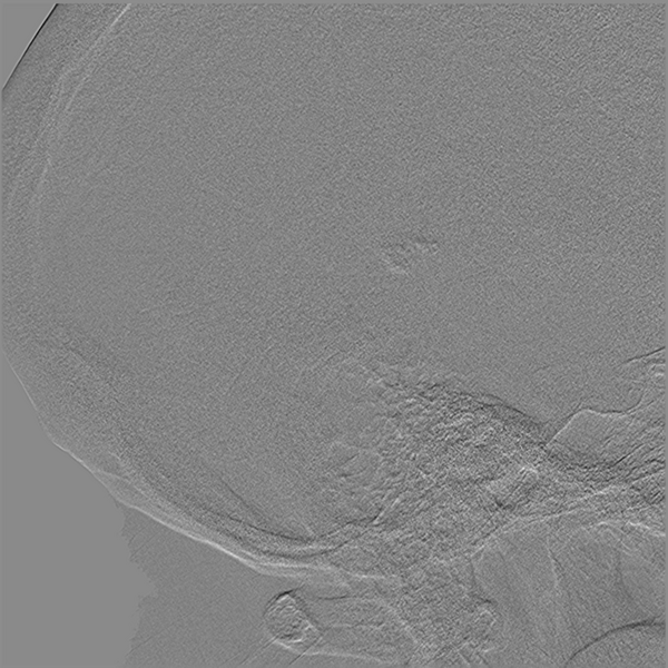 File:Normal cerebral angiogram (four vessel DSA) (Radiopaedia 41708-44649 R 6).png