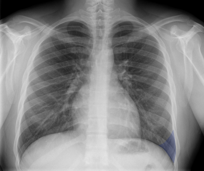 File:Normal chest x-ray - lobes (illustration) (Radiopaedia 58938-66192 F 1).png