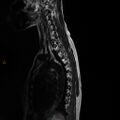 Normal spine MRI (Radiopaedia 77323-89408 E 12).jpg