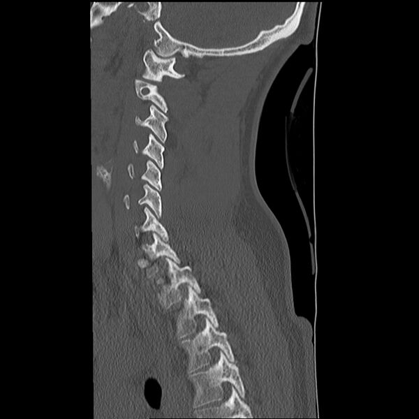 File:Normal trauma spine imaging (Radiopaedia 31753-32686 Sagittal bone window 30).jpg