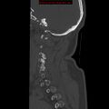 Occipital condyle fracture (Radiopaedia 18366-18208 Sagittal bone window 32).jpg