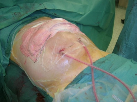 Cover of transverse laparostomy with "self-made" negative pressure dressing.
