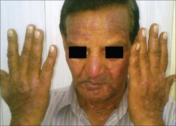 PPD contact allergic dermatitis