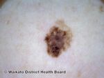 Superficial spreading melanoma, Breslow 0.5 mm, nonpolarised dermoscopy view (DermNet NZ superficial-spreading-melanoma-007-dnp).jpg