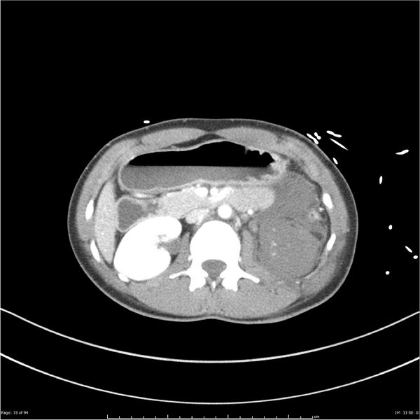 File:Traumatic renal artery dissection and pancreatic transection (Radiopaedia 37061-38739 Axial 237).jpg