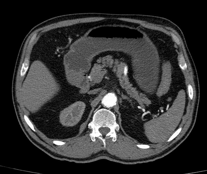 File:Abdominal aortic aneurysm (Radiopaedia 22421-22458 C+ arterial phase 18).jpg