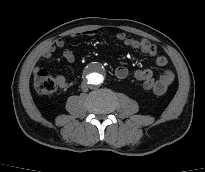 File:Abdominal aortic aneurysm (Radiopaedia 22421-22458 C+ arterial phase 51).jpg