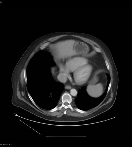 File:Abdominal aortic aneurysm with intramural hematoma then rupture (Radiopaedia 50278-55631 Axial C+ arterial phase 42).jpg