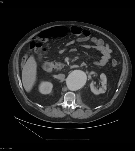 File:Abdominal aortic aneurysm with intramural hematoma then rupture (Radiopaedia 50278-55631 Axial C+ arterial phase 66).jpg