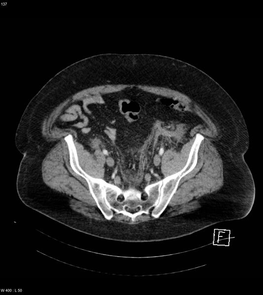 File:Abdominal aortic aneurysm with intramural hematoma then rupture (Radiopaedia 50278-55632 Axial C+ arterial phase 136).jpg