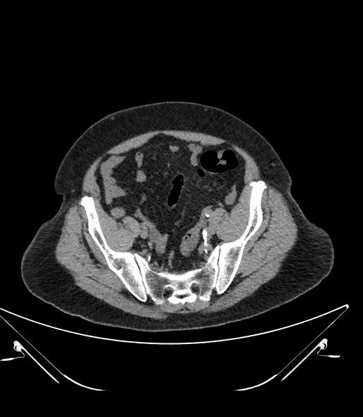 File:Abdominal aortic aneurysm with thrombus fissuration (Radiopaedia 46218-50618 Axial non-contrast 45).jpg