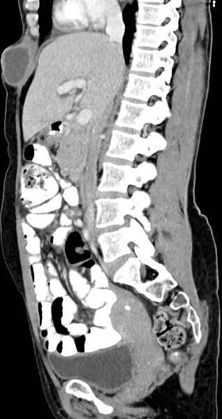 File:Abdominal wall and retroperitoneal tuberculosis (Radiopaedia 88137-104729 Sagittal C+ portal venous phase 85).jpg