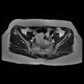 Abdominal wall endometriosis (Radiopaedia 83702-98847 Axial T2 5).jpg