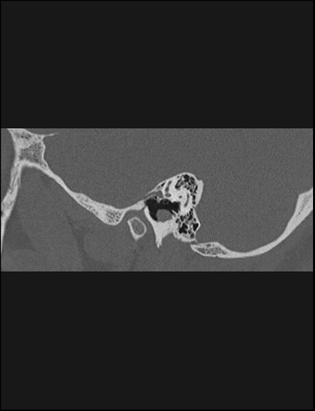 File:Aberrant right internal carotid artery (Radiopaedia 65191-74198 Sagittal non-contrast 47).jpg