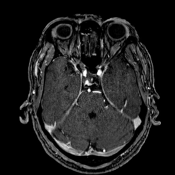 File:Accessory middle cerebral artery (Radiopaedia 73114-83828 Axial MRA 57).jpg