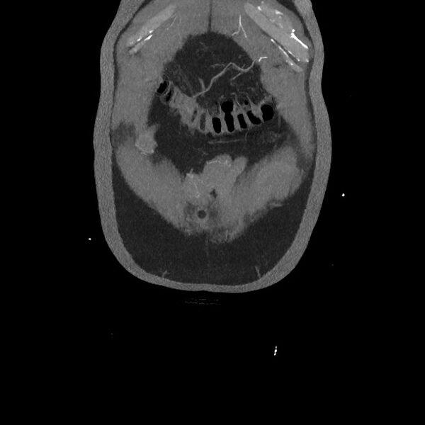 File:Active colonic bleed on CT (Radiopaedia 49765-55025 Coronal art MIP 11).jpg