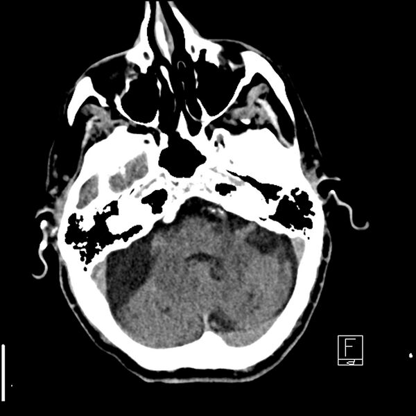 File:Acute ICA ischemic penumbra due to high-grade CCA stenosis (CT perfusion) (Radiopaedia 72038-82529 Axial non-contrast 10).jpg