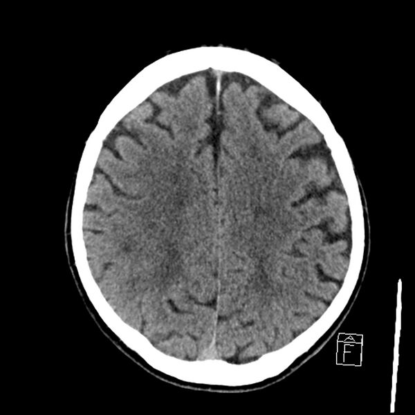 File:Acute P1 occlusion with PCA ischemia penumbra (CT perfusion) (Radiopaedia 72084-82586 Axial non-contrast 31).jpg