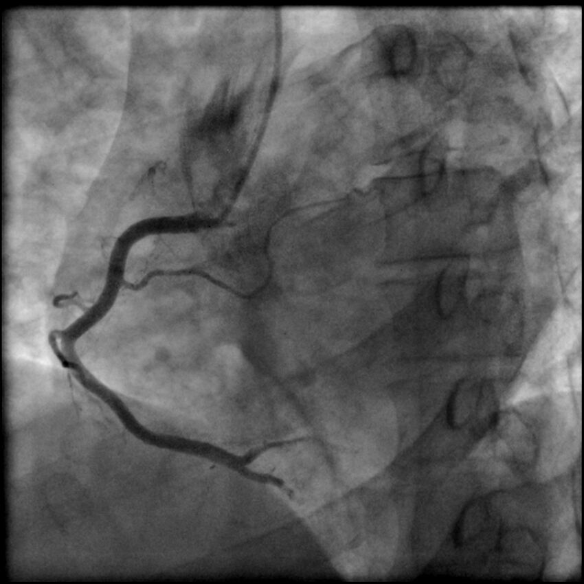 Acute anteroseptal myocardial infarction (Radiopaedia 68409-77946 RAO straight RCA 19).jpg