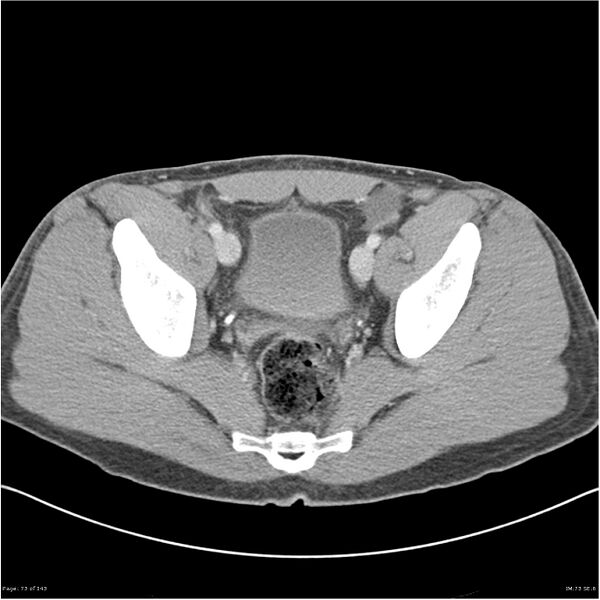 File:Acute appendicitis (Radiopaedia 25364-25615 B 63).jpg