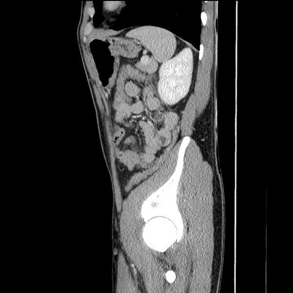 File:Acute appendicitis (Radiopaedia 27049-27227 Sagittal C+ portal venous phase 63).jpg