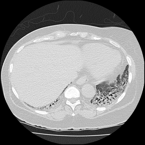 File:Acute interstitial pneumonitis (Radiopaedia 45404-49452 Axial lung window 75).jpg