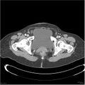 Acute pancreatitis (Radiopaedia 19136-19117 Axial C+ portal venous phase 42).jpg