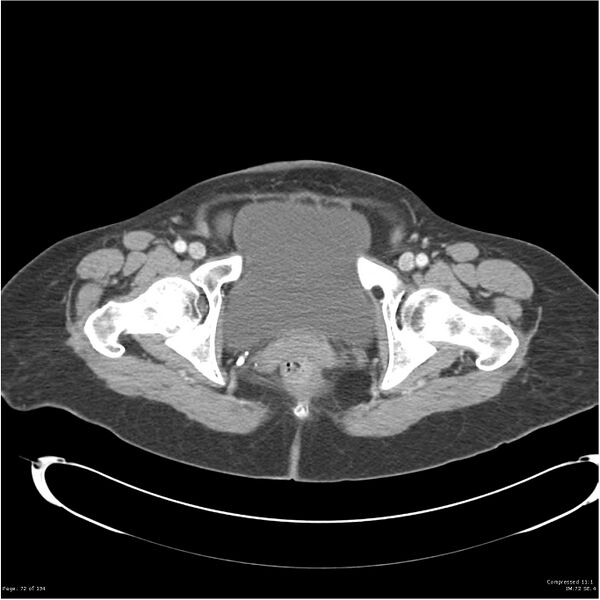 File:Acute pancreatitis (Radiopaedia 19136-19117 Axial C+ portal venous phase 42).jpg