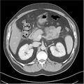 Acute pancreatitis - mild (Radiopaedia 27796-28033 C+ portal venous phase 13).jpg