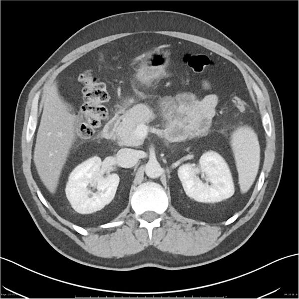 File:Acute pancreatitis - mild (Radiopaedia 27796-28033 C+ portal venous phase 13).jpg