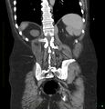 Acute renal failure post IV contrast injection- CT findings (Radiopaedia 47815-52559 Coronal C+ portal venous phase 29).jpg